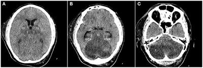 Neurologic sequelae of phosphide poisoning: A case report